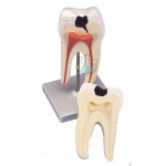 Lower Two-Rooted Molar With Caries, 2-Piece